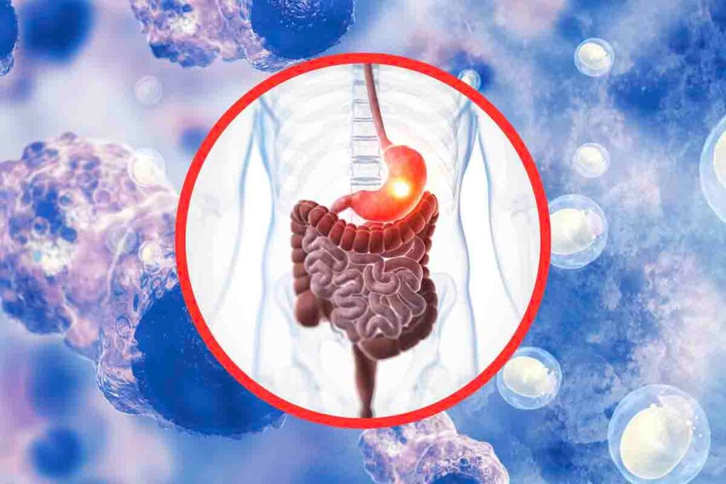 Tumore allo stomaco riconoscere i primi sintomi può salvarti la vita