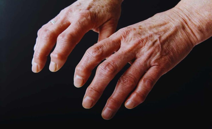 l'artrosi alle mani inzia con il dolore