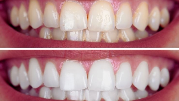 Denti bianchissimi 6 segreti sorriso
