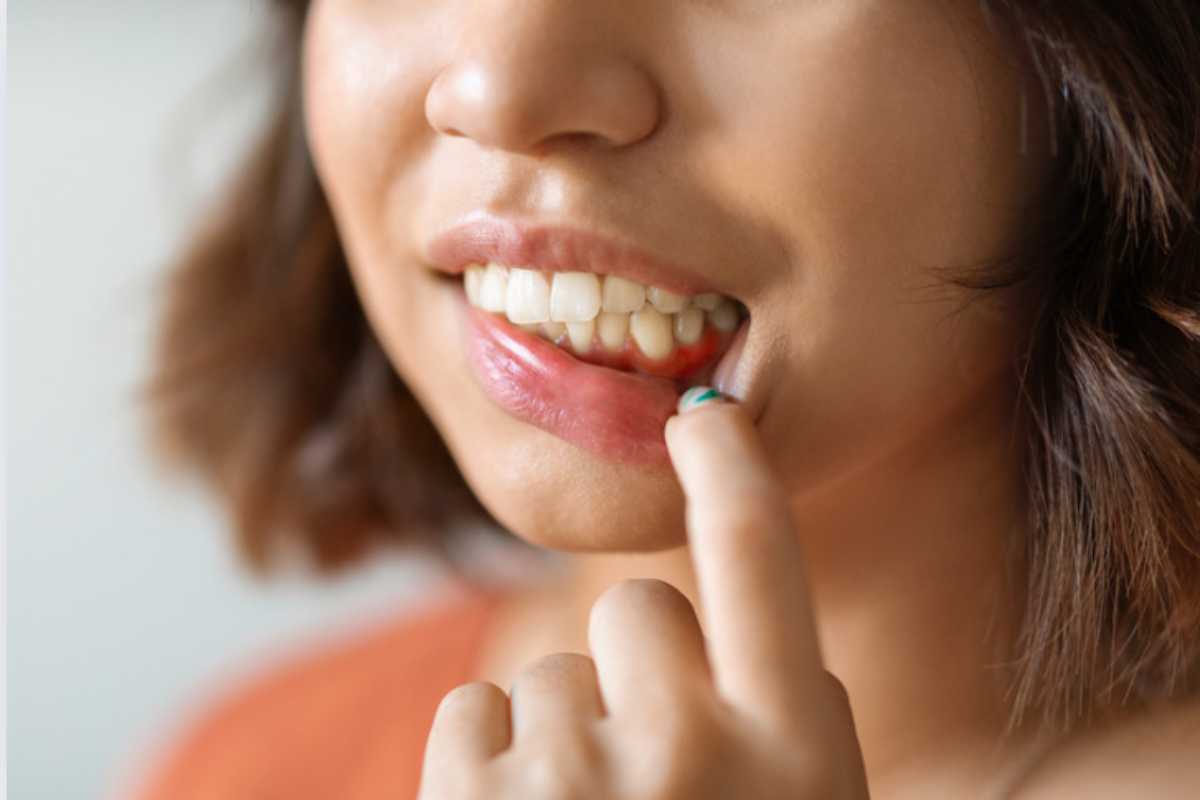 bocca segni grave malattia