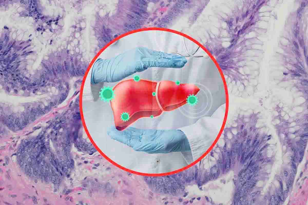 neoplasia del fegato sintomi