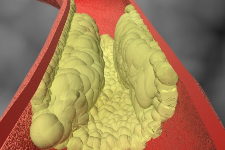 Causa insospettabile aumento colesterolo
