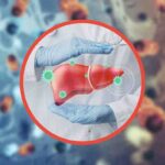 Come riconoscere i sintomi del cancro al fegato